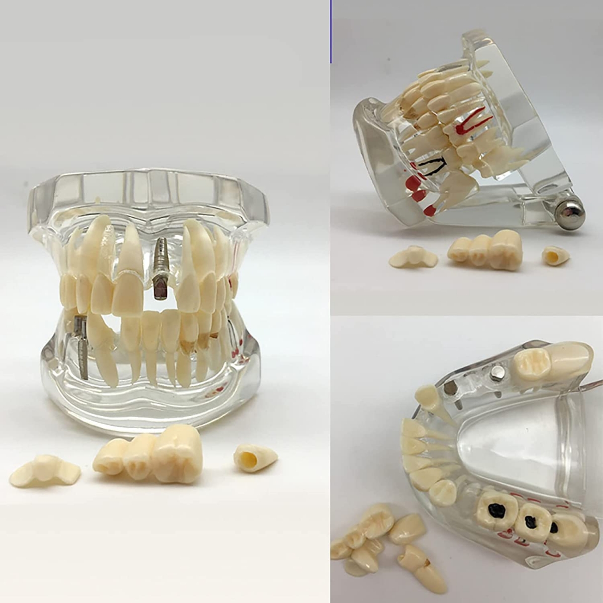 Dental Model For Patient Education With Pathologies To Demonstrate